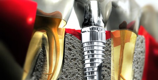 Mundhygiene bei Brücken und Implantaten - Zahnklinik OZ 95
